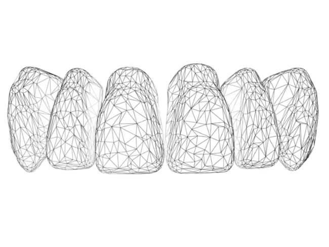 Lucitone Digital Print Denture Workflows & Costs Compared to Traditional